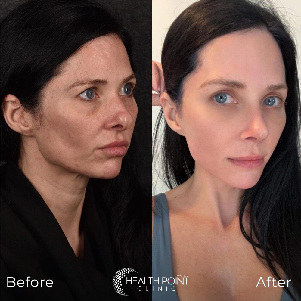 Before and After Result